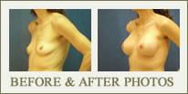 Before & After Breast Augmentation Photos