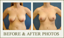 Breast Lift Before & After Photos