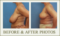 Breast Reduction Before & After Photos