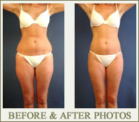 Tummy Tuck Surgery