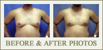 Gynecomastia Surgery