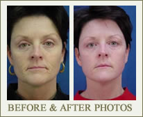 Laser Resurfacing