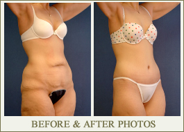 Lower Body Lift Before & After Photos Indianapolis, IN- Dr