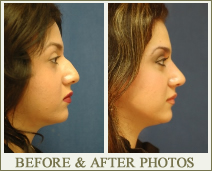 Rhinoplasty Surgery