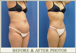 Tummy Tuck Surgery